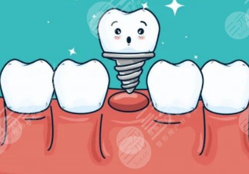 种植牙可以用社保卡报销吗？