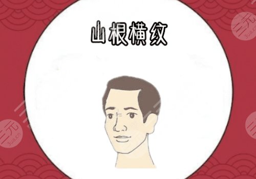 山根有横纹是怎么回事?