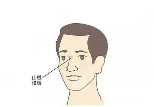 山根有横纹是怎么回事?