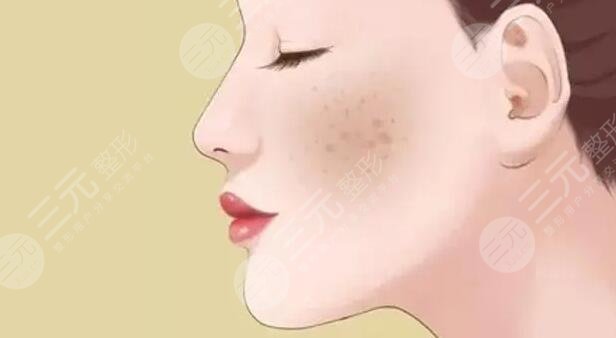 脸上黄褐斑怎么去掉好的方法小妙招
