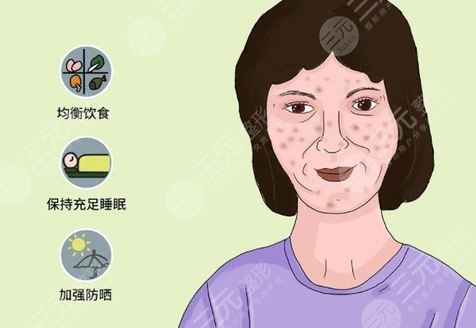 脸上黄褐斑怎么去掉好的方法小妙招