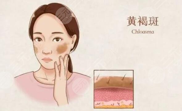 日常的祛斑方法