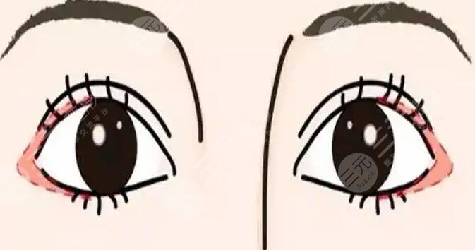 开眼角