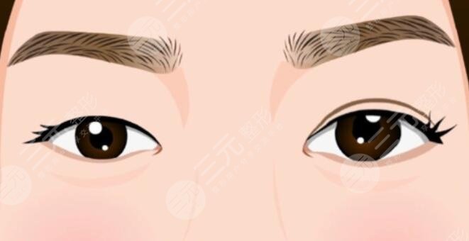 韩式眼部整形的效果如何