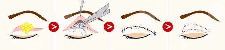 韩式眼部整形的注意事项