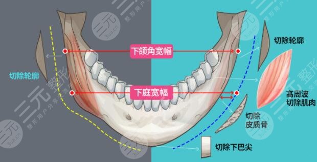 磨骨整形手术