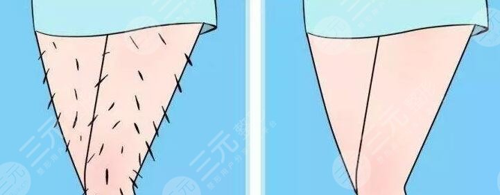 小腿激光脱毛的价格多少钱2023?