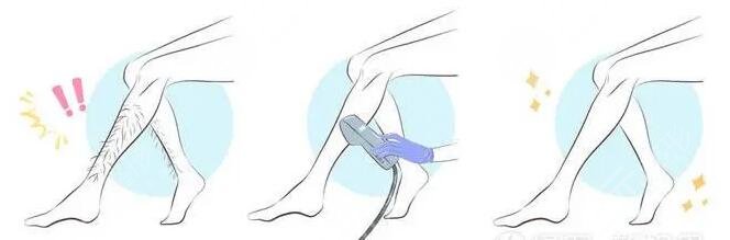 哪个季节适合激光脱毛?