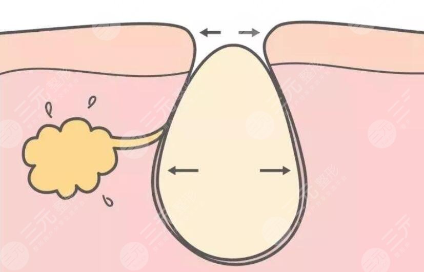 解读！   激光缓解毛孔粗大