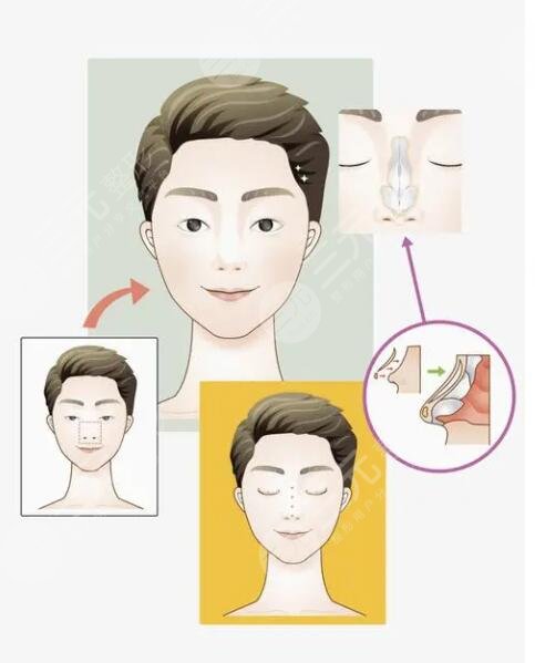 隆鼻整形手术