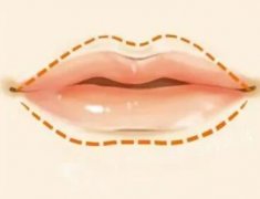 非手术丰唇方法有哪些？3种方案分享，唇真诱惑！