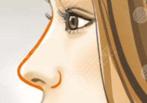 胶原蛋白隆鼻会变宽吗?