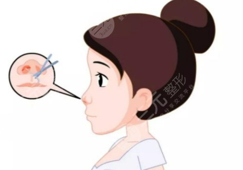 胶原蛋白隆鼻会变宽吗?