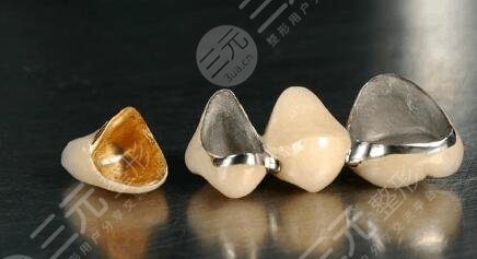 钛合金烤瓷牙套价格多少钱一颗2023？