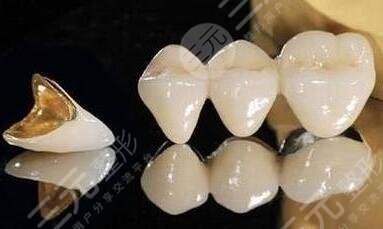 钛合金烤瓷牙套的注意事项