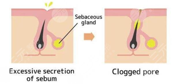 痤疮的缓解价格是多少2023?