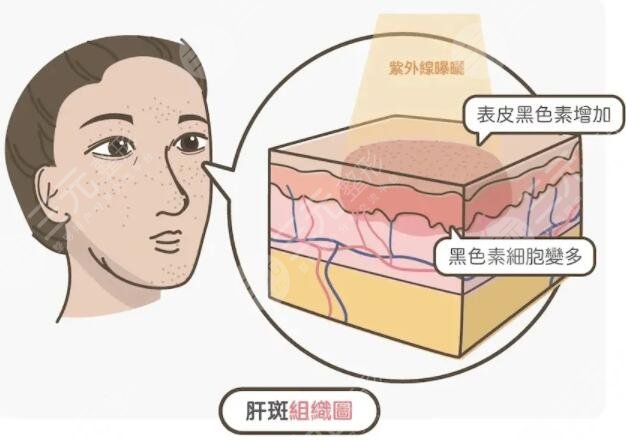 彩光祛斑的费用一般多少钱左右?