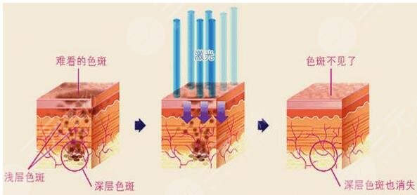 彩光祛斑注意事项有哪些?