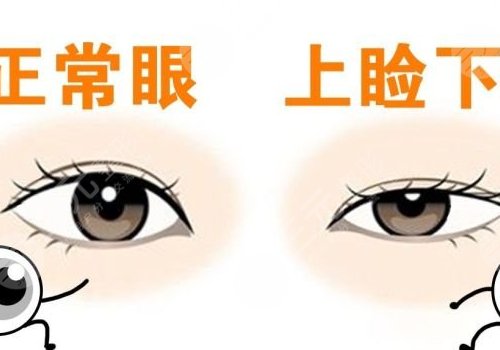 上睑下垂矫正手术有风险吗?