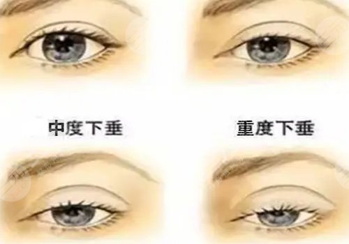 上睑下垂矫正手术有风险吗?