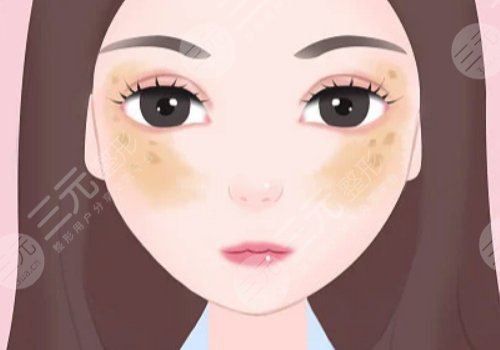 去除黄褐斑价格是多少？