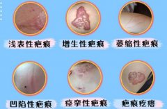 疤痕疙瘩的缓解办法科普！3种方案修复皮肤~