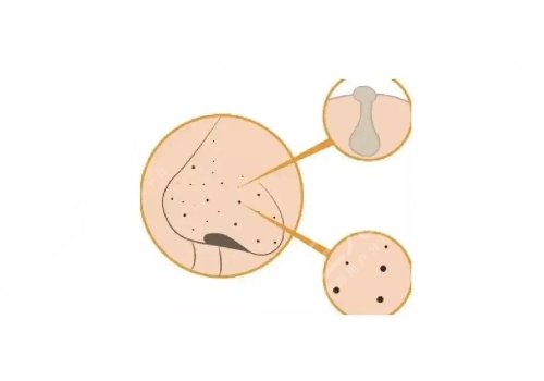 去黑头收缩毛孔好的方法有哪些？