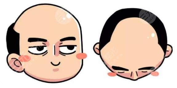 上海缓解脱发多少钱2023？药物、手术、日常护理多方位入手，解救秃头星人！