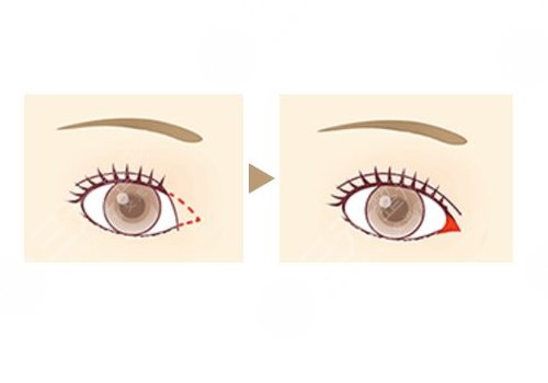 开内眼角一般多少钱？