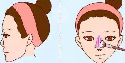 隆鼻