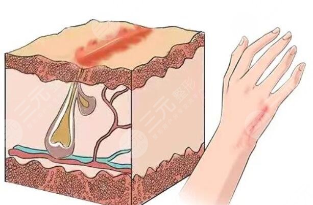 像素激光祛疤的优点有哪些?