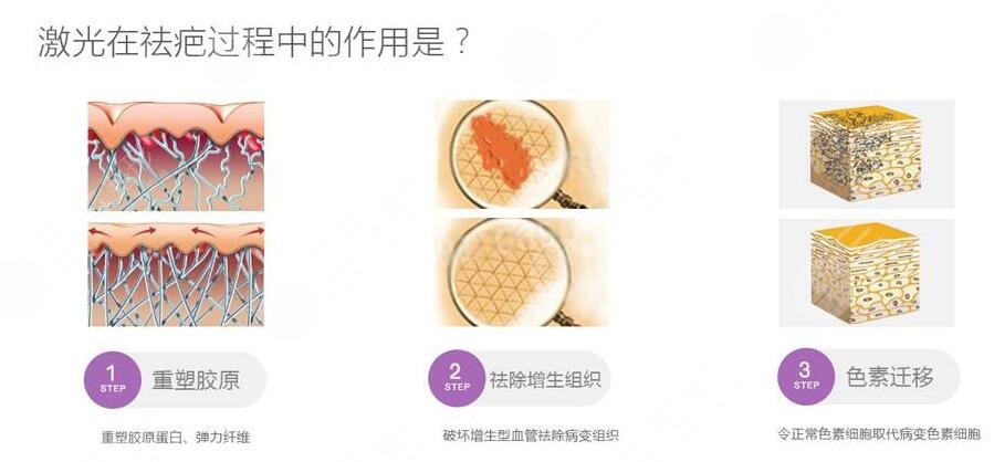 像素激光去疤的效果怎么样?