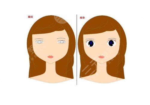 眼部整形有哪些项目？