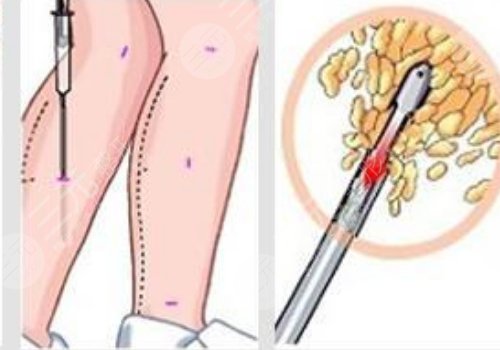 小腿吸脂大概要多少钱?