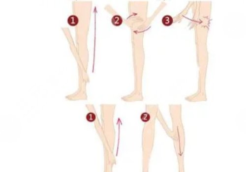 小腿吸脂大概要多少钱?