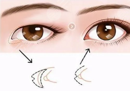 一般开内眼角多少钱?