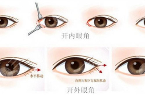 一般开内眼角多少钱?