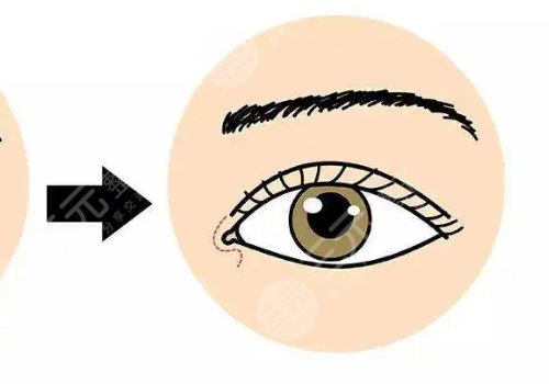 一般开内眼角多少钱?