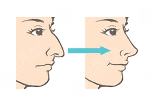 驼峰鼻矫正手术多少钱？