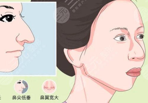 驼峰鼻矫正手术多少钱？