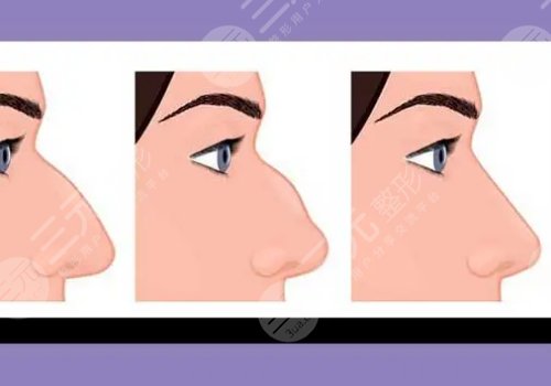 驼峰鼻矫正手术多少钱？