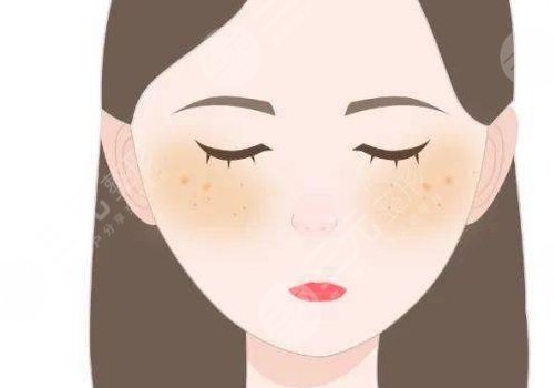 激光祛斑后反黑怎样能快速消除?