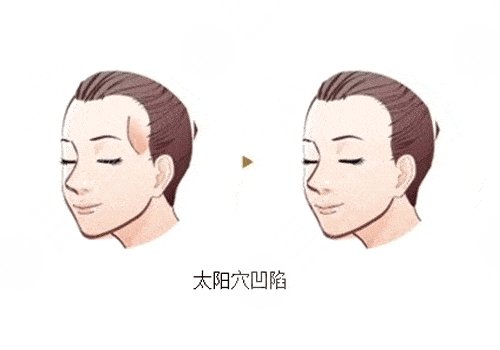 填充太阳凹陷脂肪能保持多久?