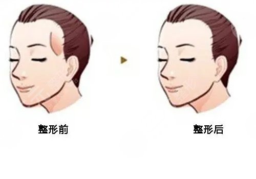 填充太阳凹陷脂肪能保持多久?