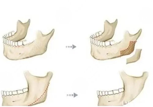 下颌角宽大怎么改良?