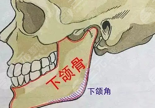 下颌角宽大怎么改良?