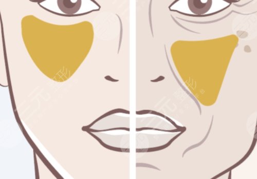 改善苹果肌凹陷的注意事项