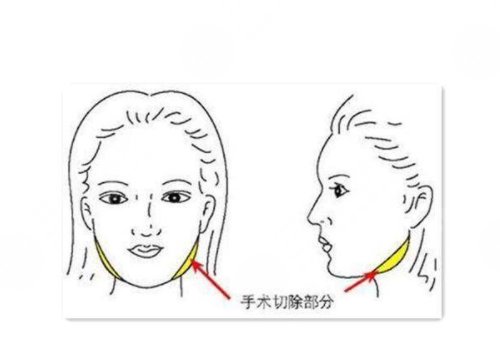 磨骨手术和削骨哪个更好?