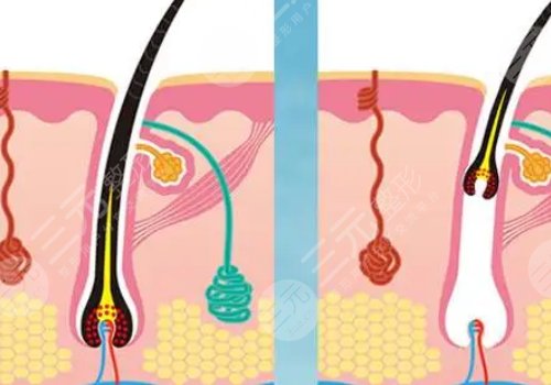 激光脱毛和冰点脱毛哪个好？