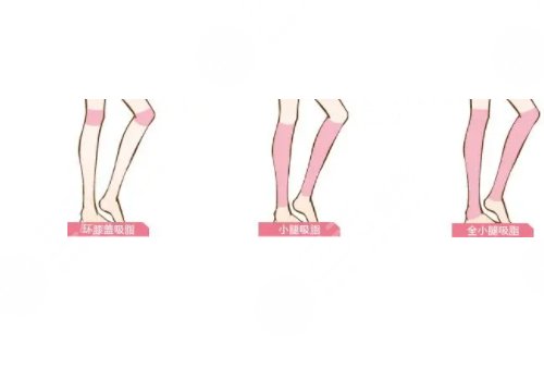 小腿吸脂恢复期要多久?有效果吗?